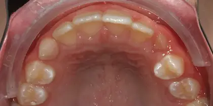 Intraoral view of upper dental arch showing primary teeth alignment in pediatric patient.