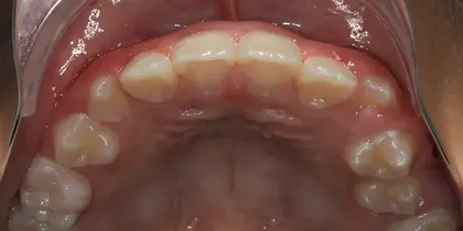 Intraoral view of upper dental arch showing natural teeth alignment and oral cavity structure.