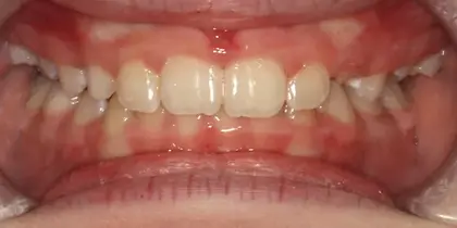 Close-up intraoral view of upper and lower teeth showing dental alignment and bite relationship.