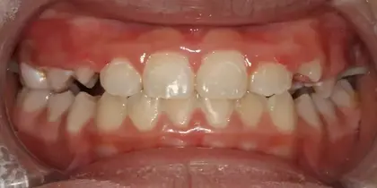 Close-up of child's teeth showing mild crowding and malocclusion in dental office setting.
