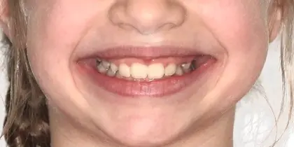 Child smiling brightly, displaying healthy teeth and genuine happiness in dental care setting.