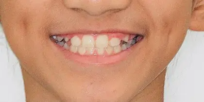 Close-up of child's smile showing teeth and gums against neutral background