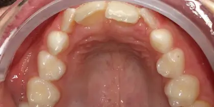 Intraoral view of upper dental arch showing healthy permanent teeth in proper alignment.