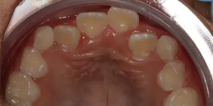Intraoral dental photograph showing upper teeth and palate from pediatric patient examination.