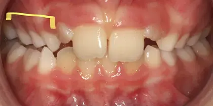 Close-up intraoral dental photograph showing upper front teeth with gaps and misalignment requiring orthodontic treatment.