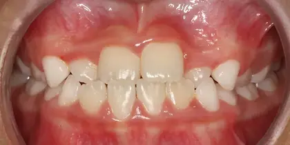 Close-up view of upper and lower teeth showing dental alignment and gum health in clinical setting.