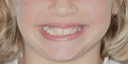 Close-up of smiling child's face showing healthy teeth and happy expression.