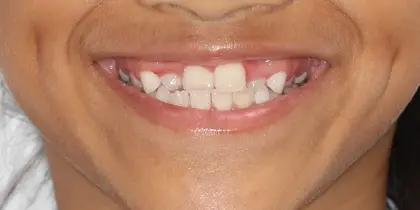 Close-up of child's smile showing teeth and gums during dental examination or consultation.