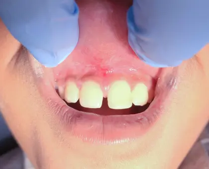 Child's open mouth showing upper front teeth with blue dental mirror during examination.