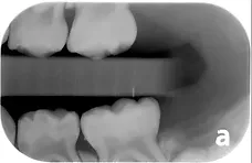 Dental X-ray showing upper and lower teeth alignment and root structure in black and white radiographic image.