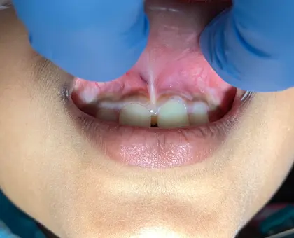 Child's smile with blue cheek retractors showing front teeth during dental examination.