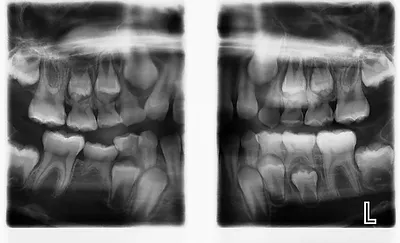 Two dental X-rays showing upper and lower jaw teeth alignment before and after orthodontic treatment.