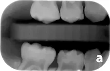 Dental X-ray showing upper and lower molars for pediatric orthodontic evaluation.
