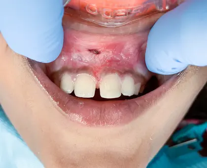 Child's open mouth showing upper front teeth during dental examination with blue background