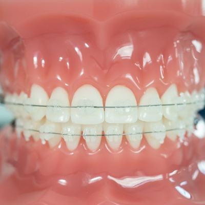 Dental model showing white braces on upper and lower teeth with pink gums.