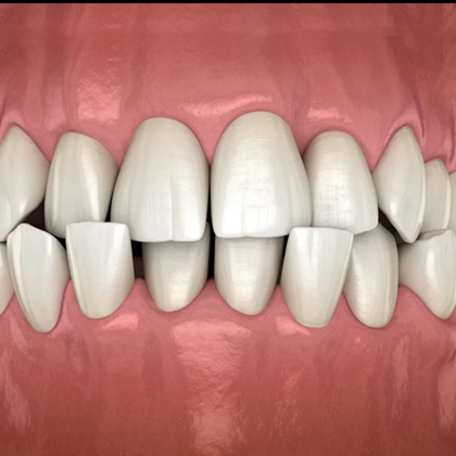 Digital rendering of properly aligned white teeth with pink gums showing ideal orthodontic treatment results.