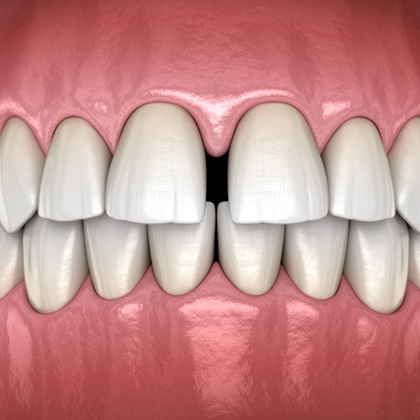Digital illustration of upper and lower teeth with gap between front teeth showing diastema condition.