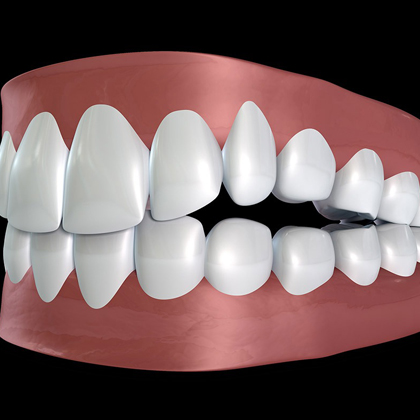 3D dental model showing white teeth aligned on pink gum base against black background.