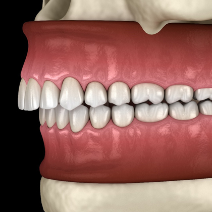3D dental model showing upper and lower teeth alignment and gum structure for orthodontic education.