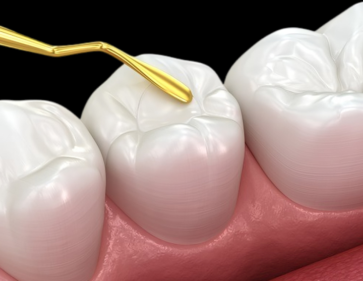 Dental sealant application on tooth surface with instrument during preventive pediatric dental procedure.