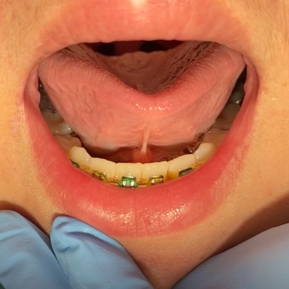 Child's open mouth showing lower teeth with metal braces during dental examination.