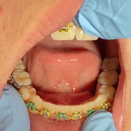 Close-up intraoral view of lower teeth with colorful orthodontic braces and brackets during dental examination.