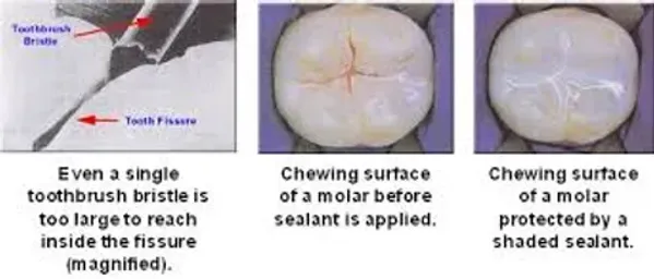 Toothbrush bristle demonstration and dental molar surfaces showing chewing areas with and without sealant.
