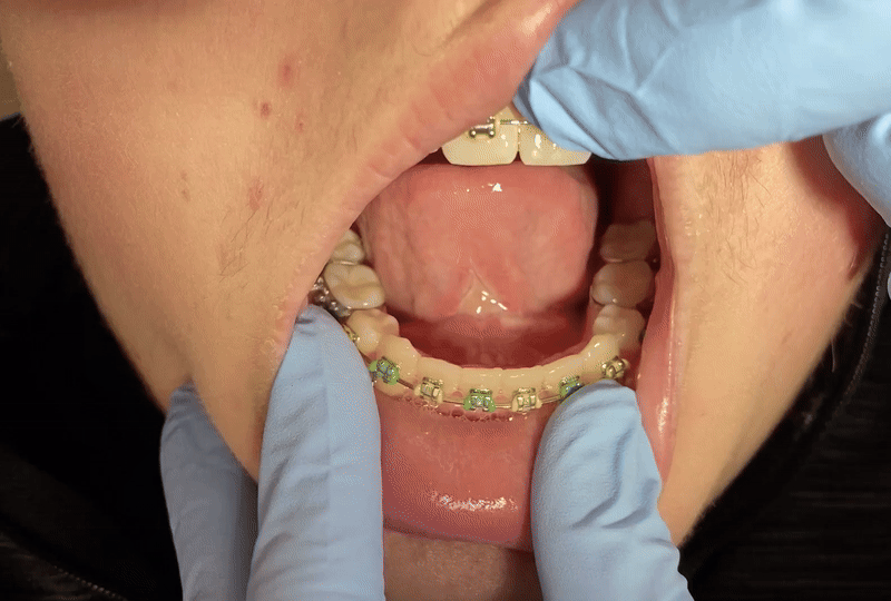 Pediatric dental examination showing child's open mouth with gloved hands performing oral inspection.