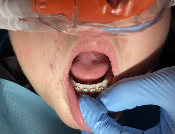 Dental professional examining child's open mouth during orthodontic evaluation or treatment visit.