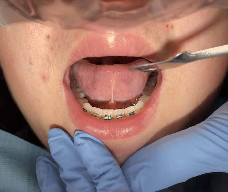 Pediatric dental examination showing child's open mouth with lingual braces during orthodontic treatment.