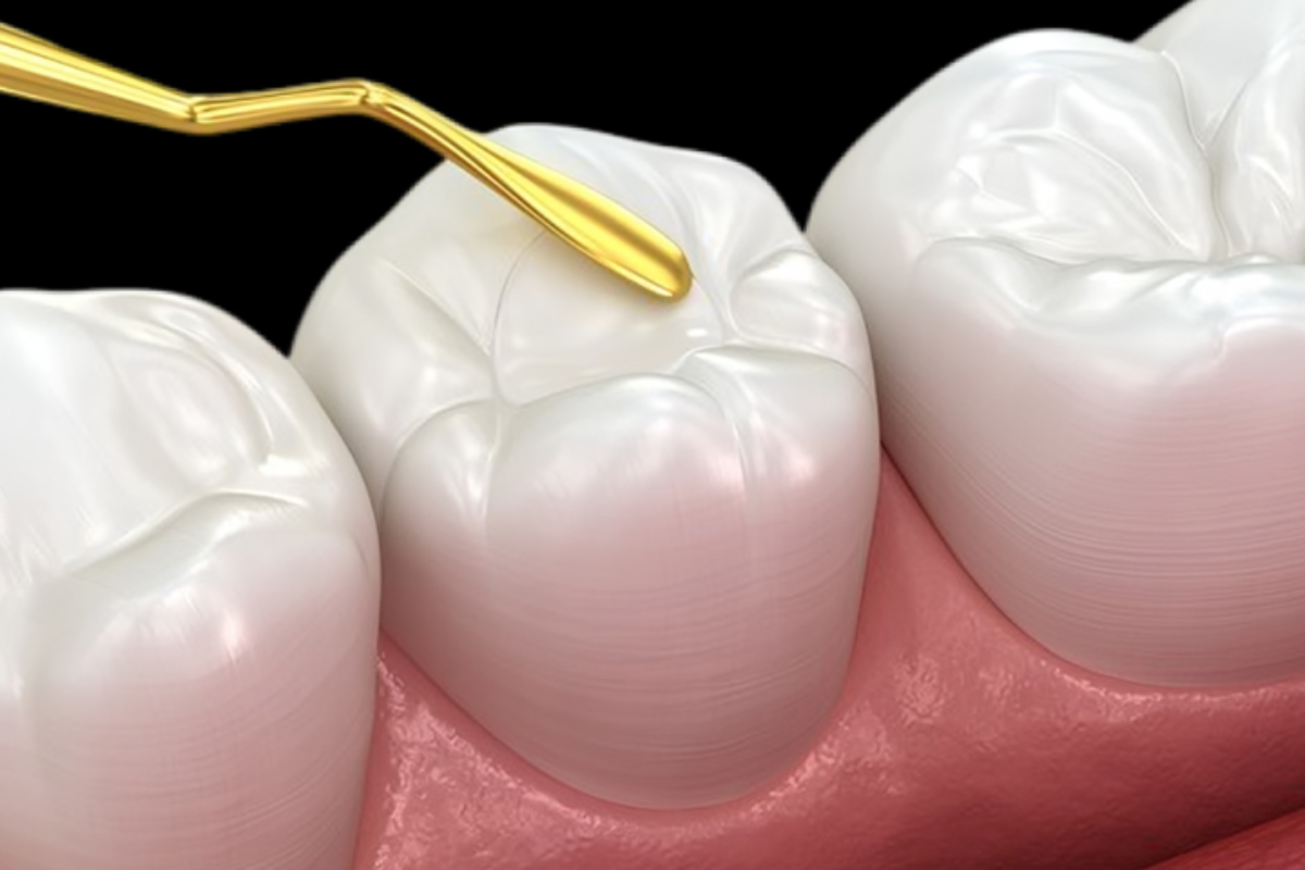Dental professional applying fluoride treatment to child's teeth using applicator brush.